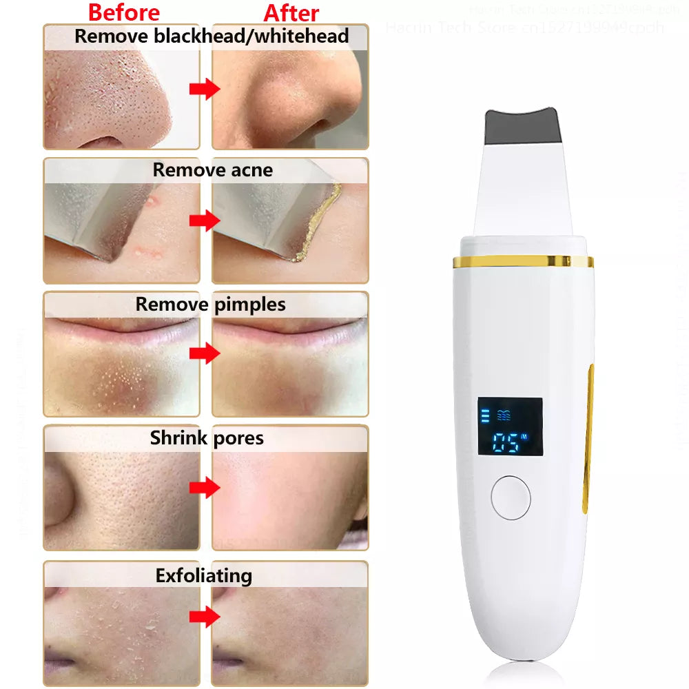 Z9 Ultrasonic Skin Scrubber