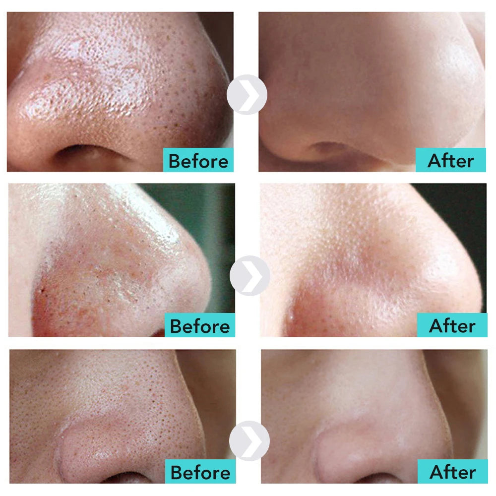 Blackhead Remover Nose Mask