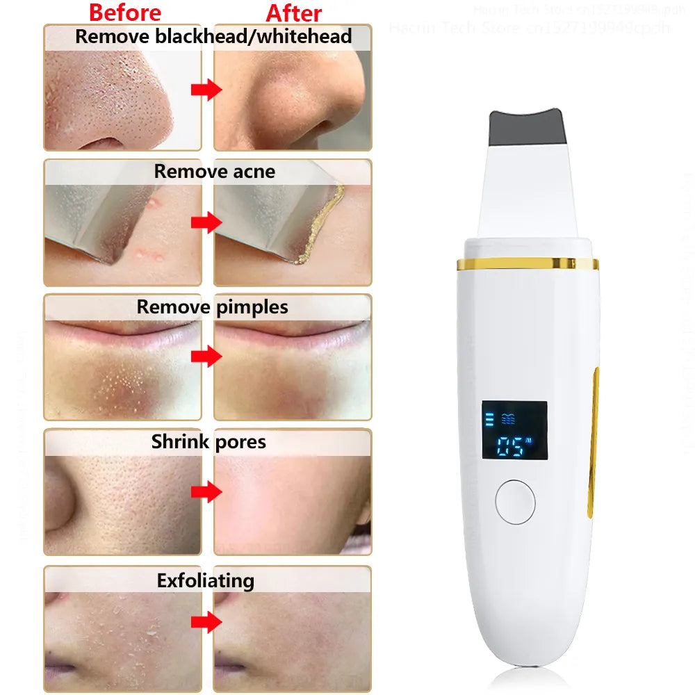 Z9 Ultrasonic Skin Scrubber